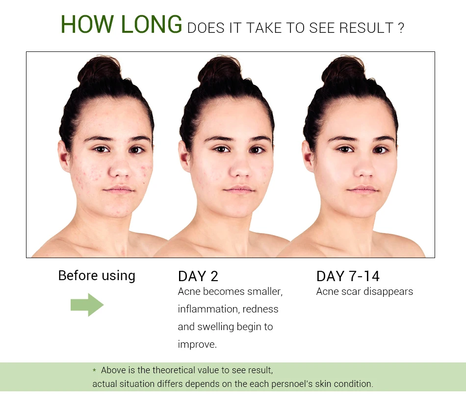 OMY LADY wholesale korea acne scar removal face anti acne whitening cream